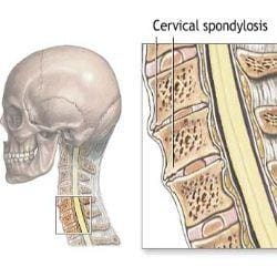 Blog Image 2 - Cervical Spondylosis Diagram