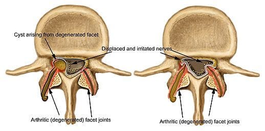 Blog Image 2 - Facet Joint Arthritis
