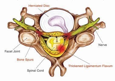 Blog Image 2 - Radiculopathy compression