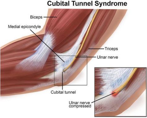 Cubital Tunnel Syndrome Anatomy - El Paso Chiropractor