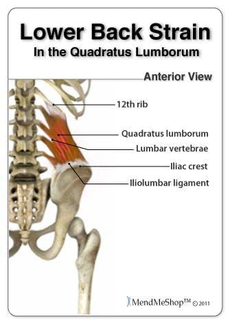 Quadratus Lumborum Strain - El Paso Chiropractor