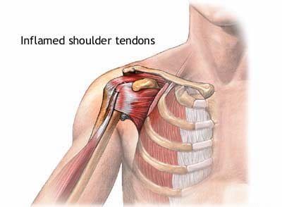 Shoulder Tendonitis Diagram - El Paso Chiropractor