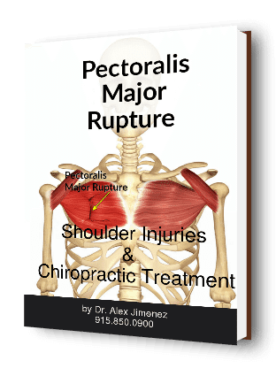blog picture of anatomical pectoralis major rupture