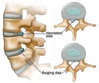 Herniated Disc Vs Bulging Disc
