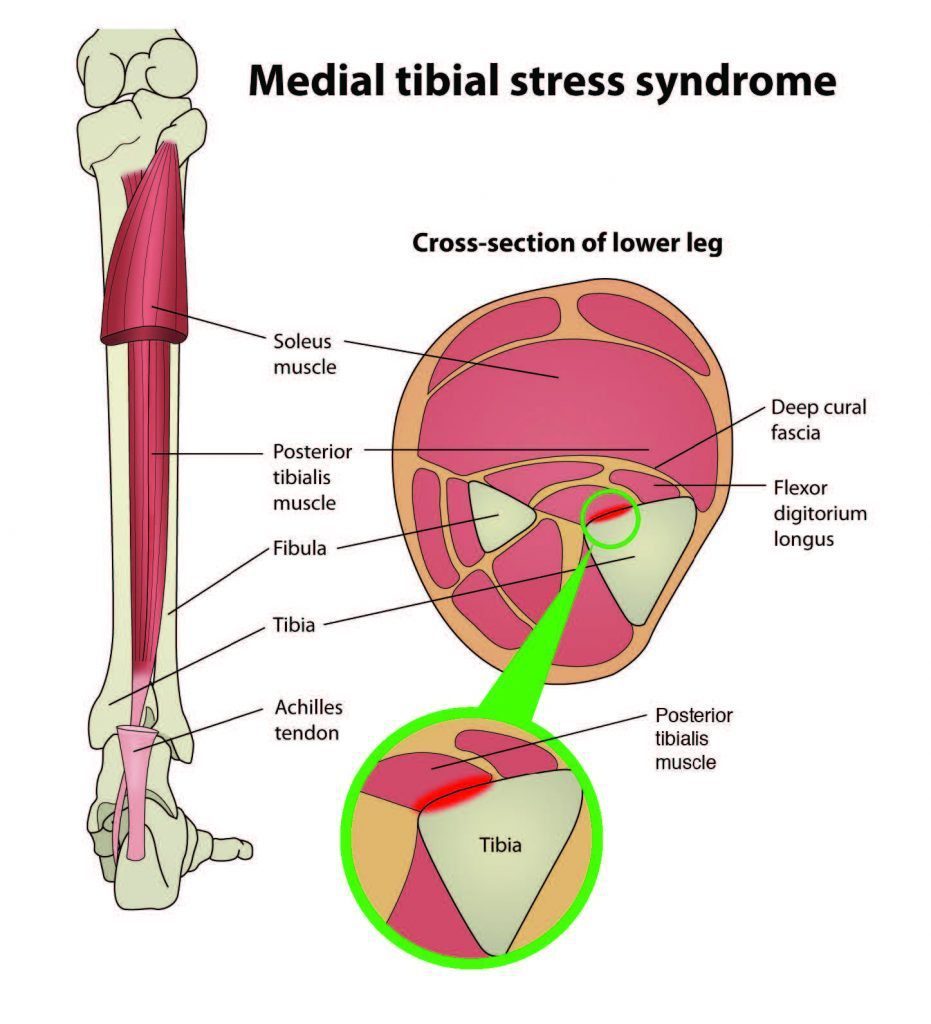 Anatomy ee lugta hoose iyo MTSS - El Paso Chiropractor