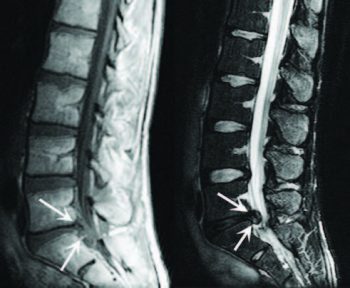 Lumbar Spine Disc Herniation Imaging - El Paso Chiropractor
