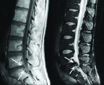 Columna lumbar Hernia del disco de imagen - El Paso Quiropráctico