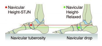 Navicular Drop Test - El Paso Chiropractor