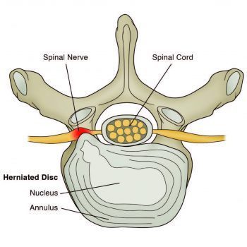 Herniated Lumbar Disc Diagram - El Paso Chiropractor