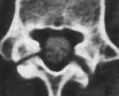 CT Scan of Bilateral Fractures - El Paso Chiropractor