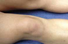 Puffy Knee Demonstration - El Paso Chiropractor