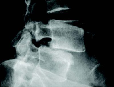 Conventional Radiology Spondylolisthesis - El Paso Chiropractor