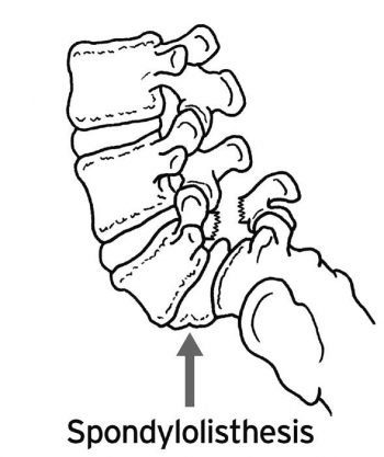 Spondylolisthesis Diagram - El Paso Chiropractor