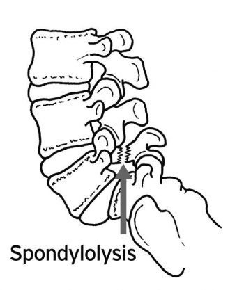 Spondylolysis Diagram - El Paso Chiropractor