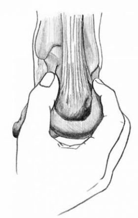 Squeeze Test for Plantar Heel Pain - El Paso Chiropractor