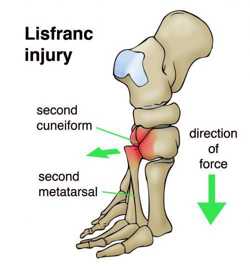 Lisfranc Injury Mechanism of Injury - El Paso Chiropractor