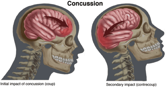 Blood Markers Could Detect Concussion