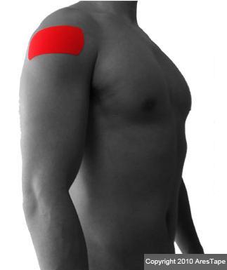 blog picture of male upper body with kinesiotape applied to shoulder