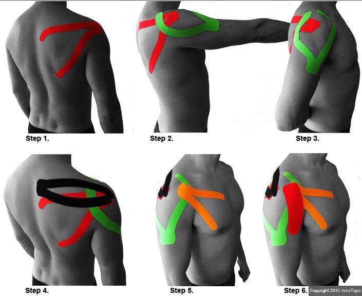 six blog pictures of male upper body with kenisitape applied to shoulders in various stages 