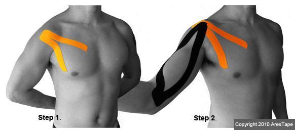 two blog pictures of male upper body with kenisiotape applied to shoulder and chest area