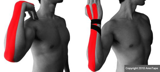 blog picture of male upper body with kinesiotape applied to elbow, forearm, and wrist