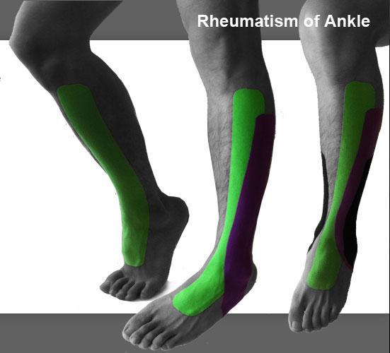 blog picture of male shins and feet with kinesiotape applied to knee down to foot and ankle