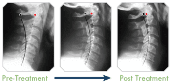 blog picture of three x-rays of neck in pre treatment to post treatment