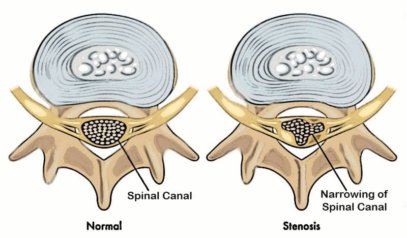 11860 Vista Del Sol, Ste. 128 Sintomi della stenosi spinale Diagnosi e trattamento precoci