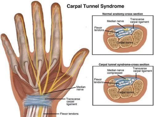 Sindrome del tunnel carpale ElPaso Chiropratico