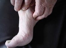 Symptoms of Peripheral Neuropathy