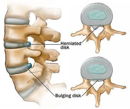11860 Vista Del Sol, Ste. 128 Chiropractic Posterior Adjustments for Bulging Discs