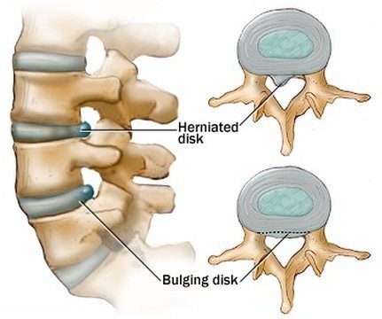 11860 Vista Del Sol, Ste. 128 Bulging Discs and Chiropractic Posterior Adjustments 