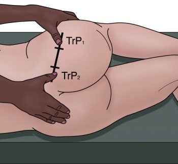Location of PM Trigger Points - El Paso Chiropractor