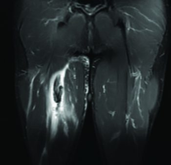 MRI Image of Avulsed Muscle - El Paso Chiropractor
