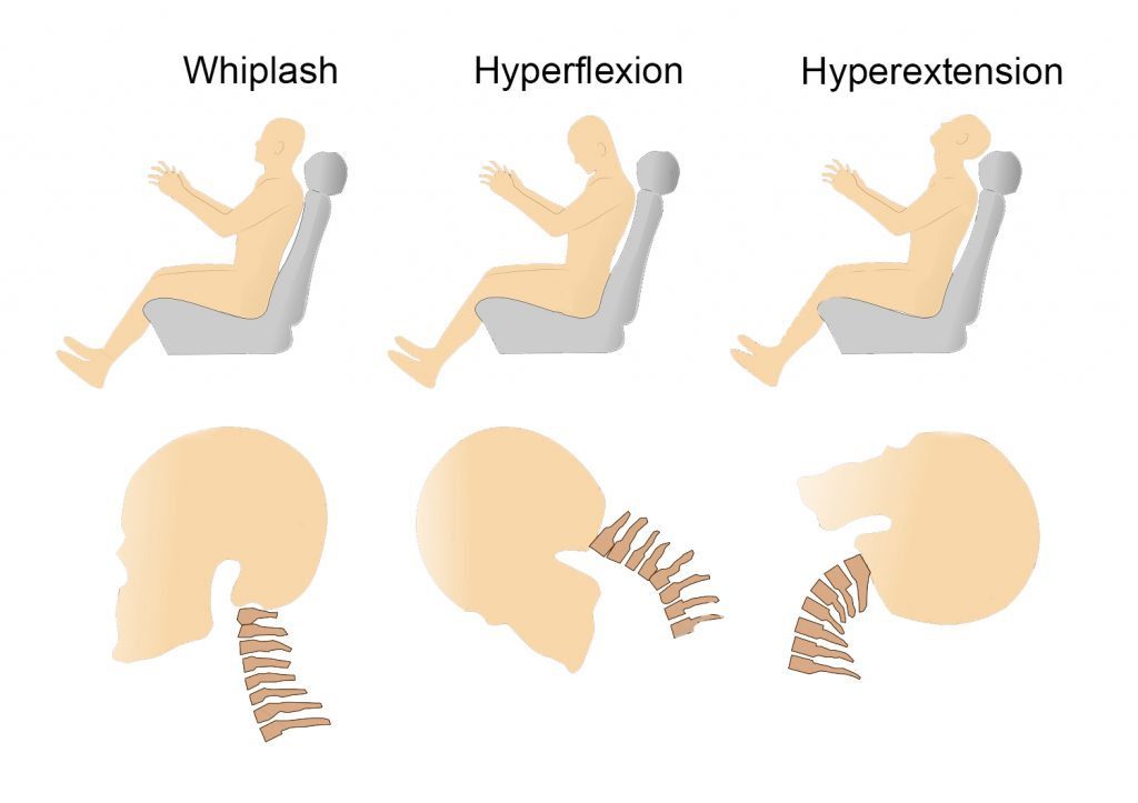 automobile illustration of person experiencing whiplash