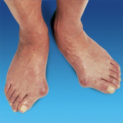 blog picture of feet with bunions