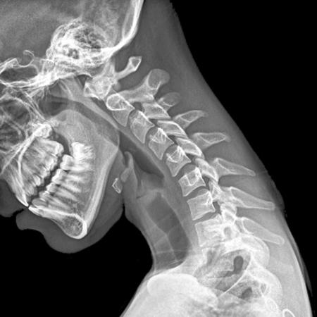 blog nga hulagway sa x-ray sa liog nga nagtan-aw sa ubos