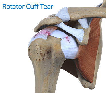 blog picture of anatomical shoulder injury