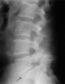 ag spinaldisorders spondy  BB