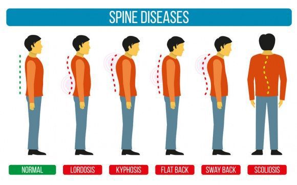 Anomalías espinales que la quiropráctica puede ayudar a el paso tx.