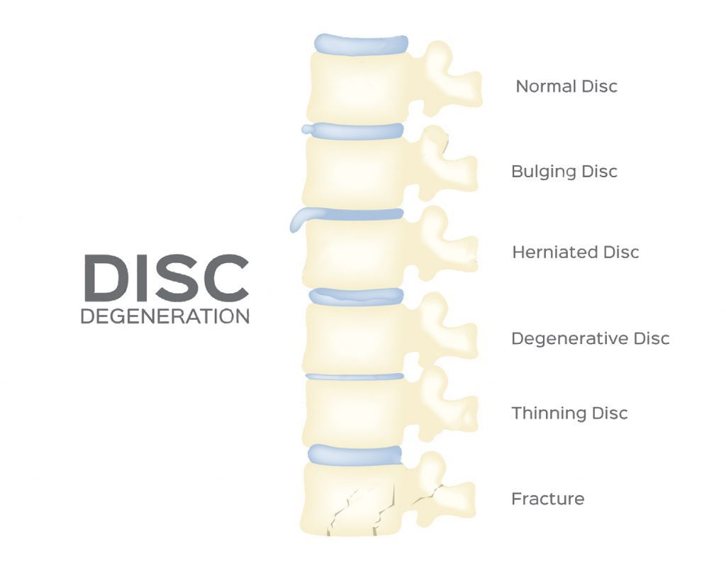 spine disc degeneration vector back bone organ anatomy