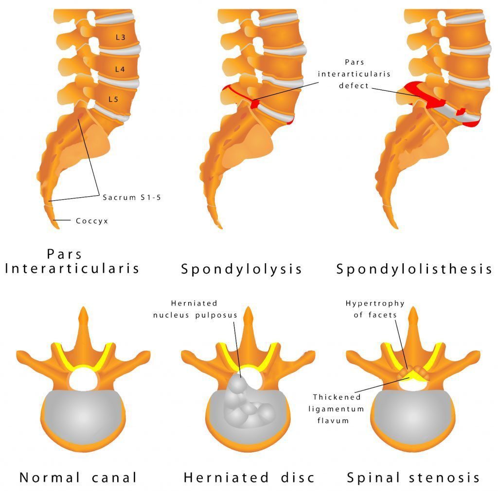 spondylolisthesis chiropractic care el paso tx.