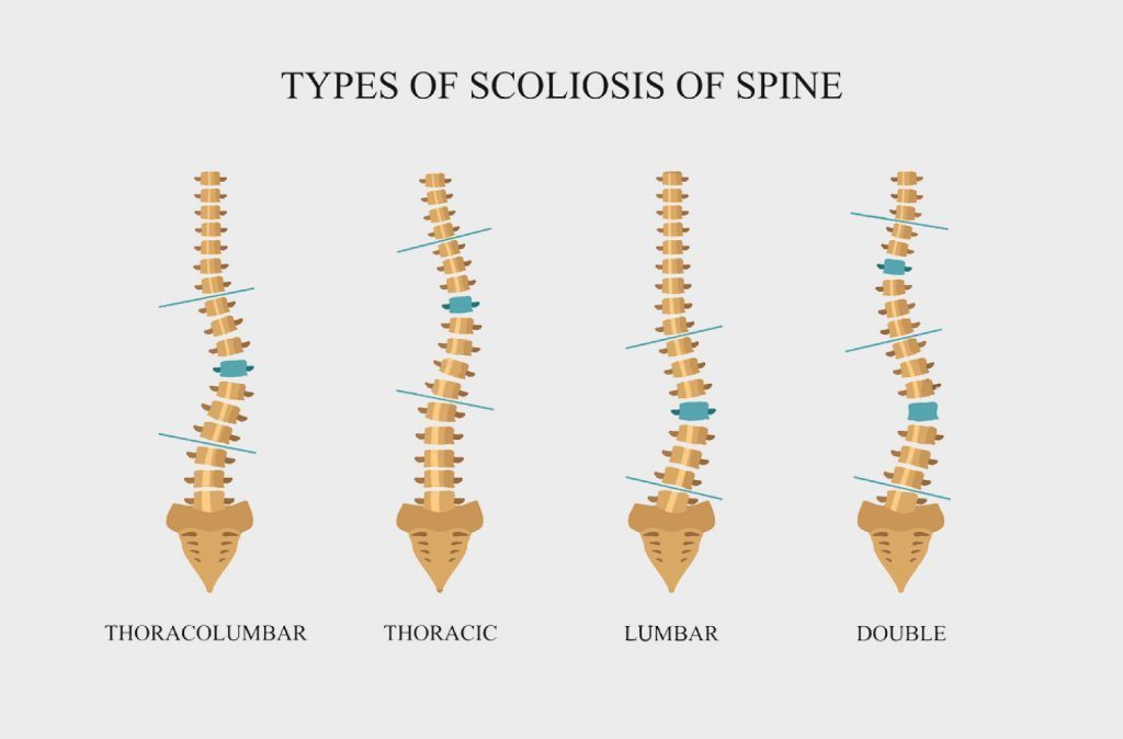 tipos de escoliosis de la columna vertebral