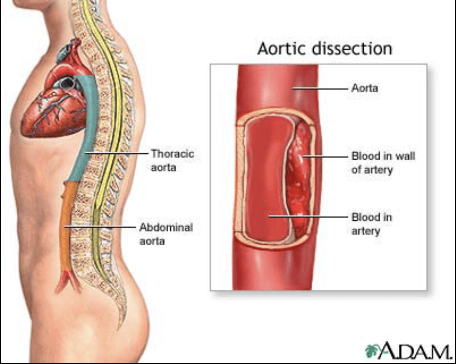 aortic dissection
