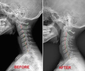 Before and After Treatment - El Paso Chiropractor