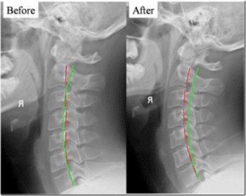 Before and After Cervical Lordosis - El Paso Chiropractor