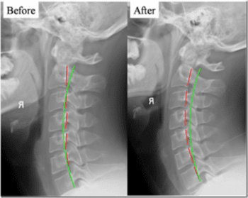 Prima e Dopo la Lancosia Cervicale - El Paso Chiropratico