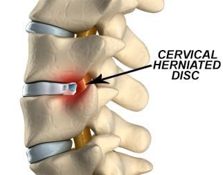 Cervical Herniated Disc - El Paso Chiropractor
