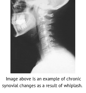Chronic Whiplash Image - El Paso Chiropractor