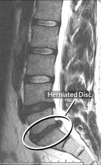 Circled Herniated Disc on MRI - El Paso Chiropractor
